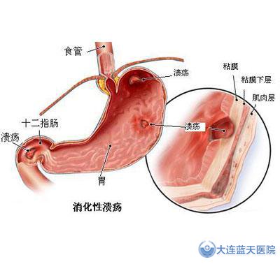 大连春柳医院-胃溃疡