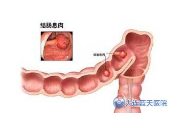 大连春柳医院-结肠息肉