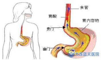 胃炎