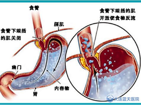 孕妇食管反流怎么办