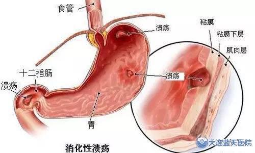 大连做胃溃疡检查需要多长时间