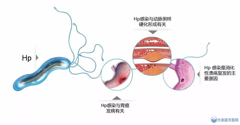 注意！胃溃疡癌变的信号有哪些？