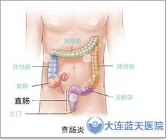 大连春柳胃肠医院告诉您：直肠炎症状有哪些？