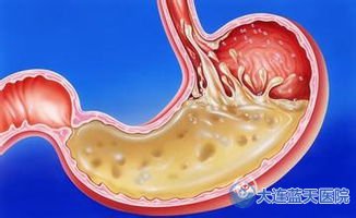 大连春柳医院告诉你如何分清楚胃溃疡！
